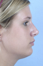Rhinoplasty Before and After Pictures Baltimore, MD