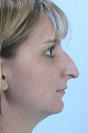 Rhinoplasty Before and After Pictures Baltimore, MD