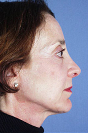 Revision Rhinoplasty Before and After Pictures Baltimore, MD