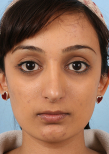 Ethnic Rhinoplasty Before and After Pictures Baltimore, MD