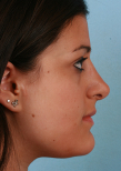 Ethnic Rhinoplasty Before and After Pictures Baltimore, MD